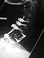 Anterior and posterior cervical spine fusion lateral view 